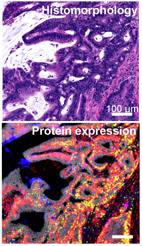 single-cell multiplex imaging, expression, histology, tumor, cancer
